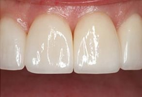 Winchester Dental | Ceramic Crowns, Dental Bonding and ZOOM  Whitening