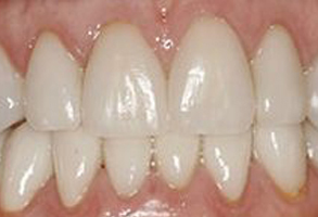 Winchester Dental | Ceramic Crowns, Invisalign reg  and Botox reg