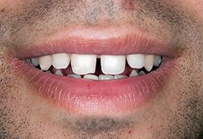 Winchester Dental | Implant Dentistry, Root Canals and Dentures