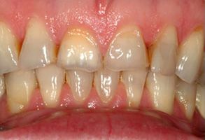 Winchester Dental | Botox reg , Dental Bridges and ZOOM  Whitening